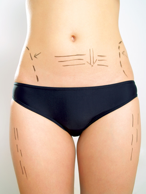 abdomioplastia