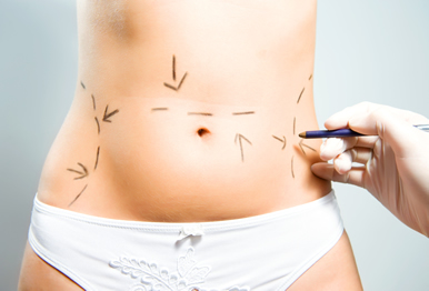 abdomioplastia