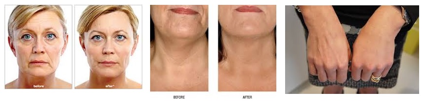 skinboosters