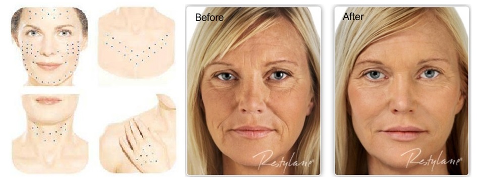 skinboosters