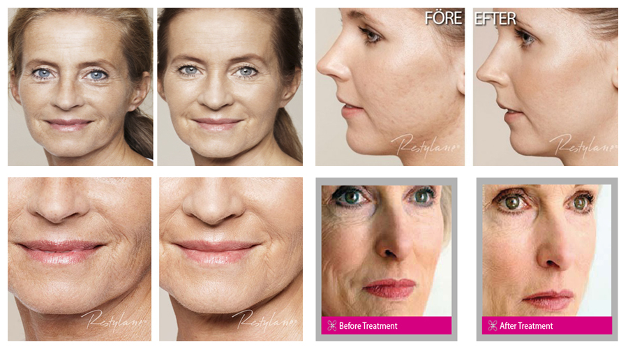 skinboosters